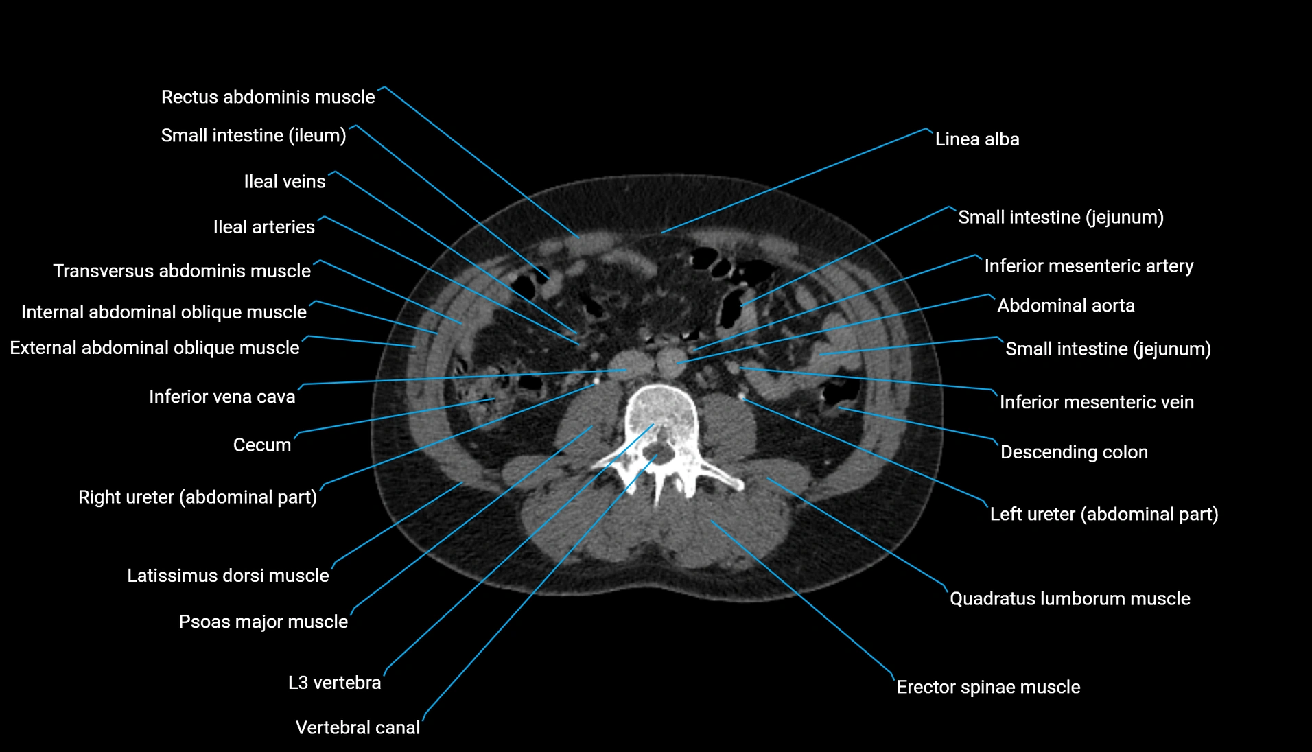CT urogram axial cross sectional anatomy  labelled radiology image-00133.webp